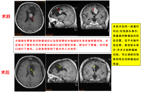 矢狀竇旁腦膜瘤案例