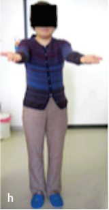 腦干腫瘤