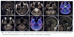 腦干腦橋腫瘤有哪些類型和新療法？治療、預后有何不同？