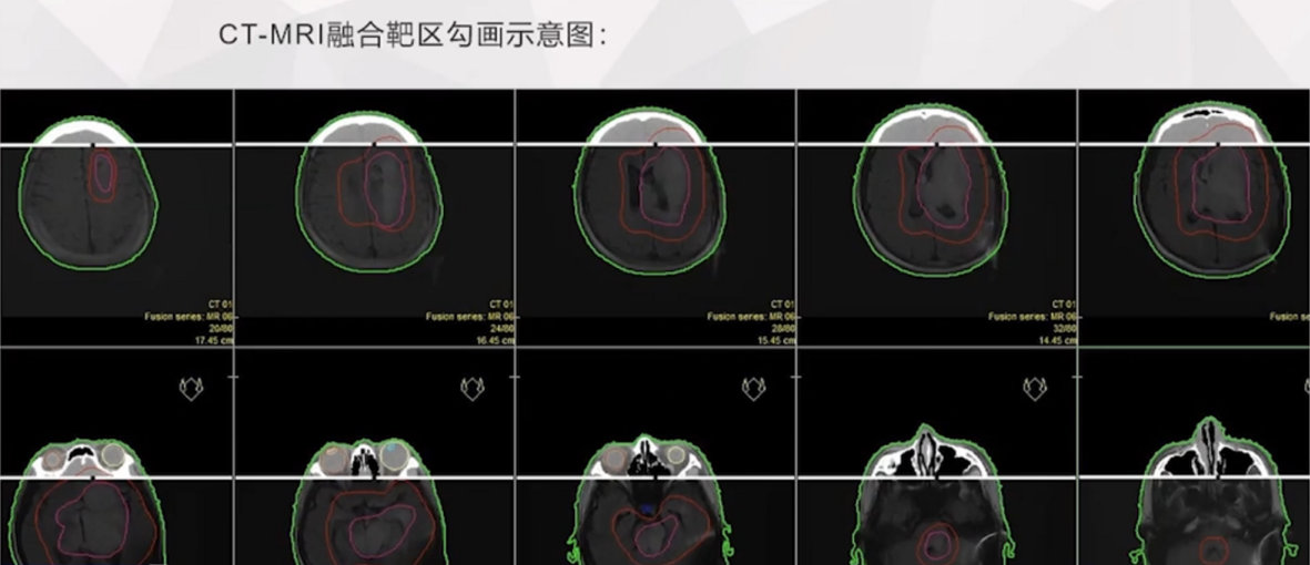 較大丘腦膠質(zhì)瘤治療