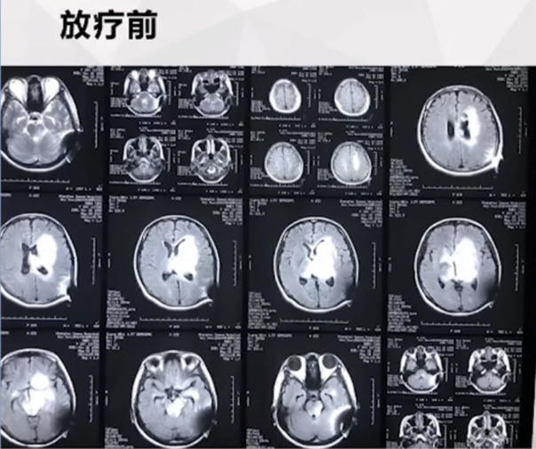 較大丘腦膠質(zhì)瘤治療