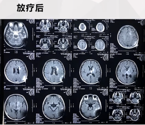 較大丘腦膠質(zhì)瘤治療