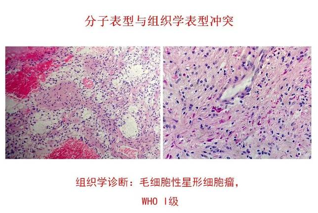膠質(zhì)瘤