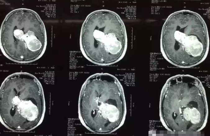 良性腦瘤癥狀