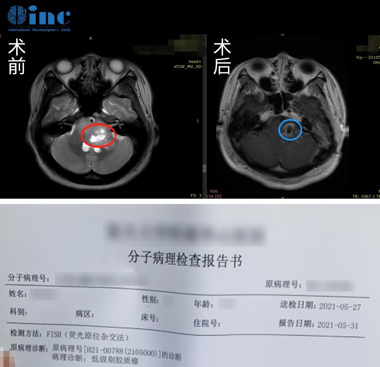 腦干膠質(zhì)瘤手術(shù)案例