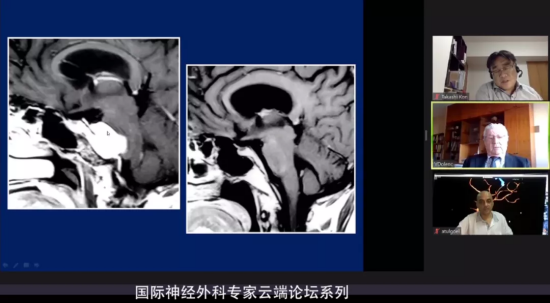 海綿竇腦膜瘤的手術(shù)治療