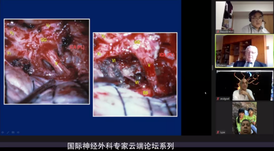 海綿竇腦膜瘤的手術(shù)治療