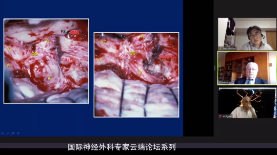 海綿竇腦膜瘤的手術(shù)治療_術(shù)后