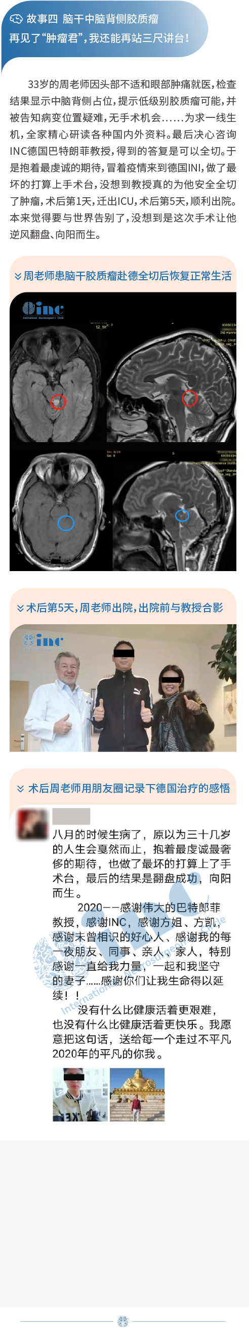 腦干中腦膠質(zhì)瘤