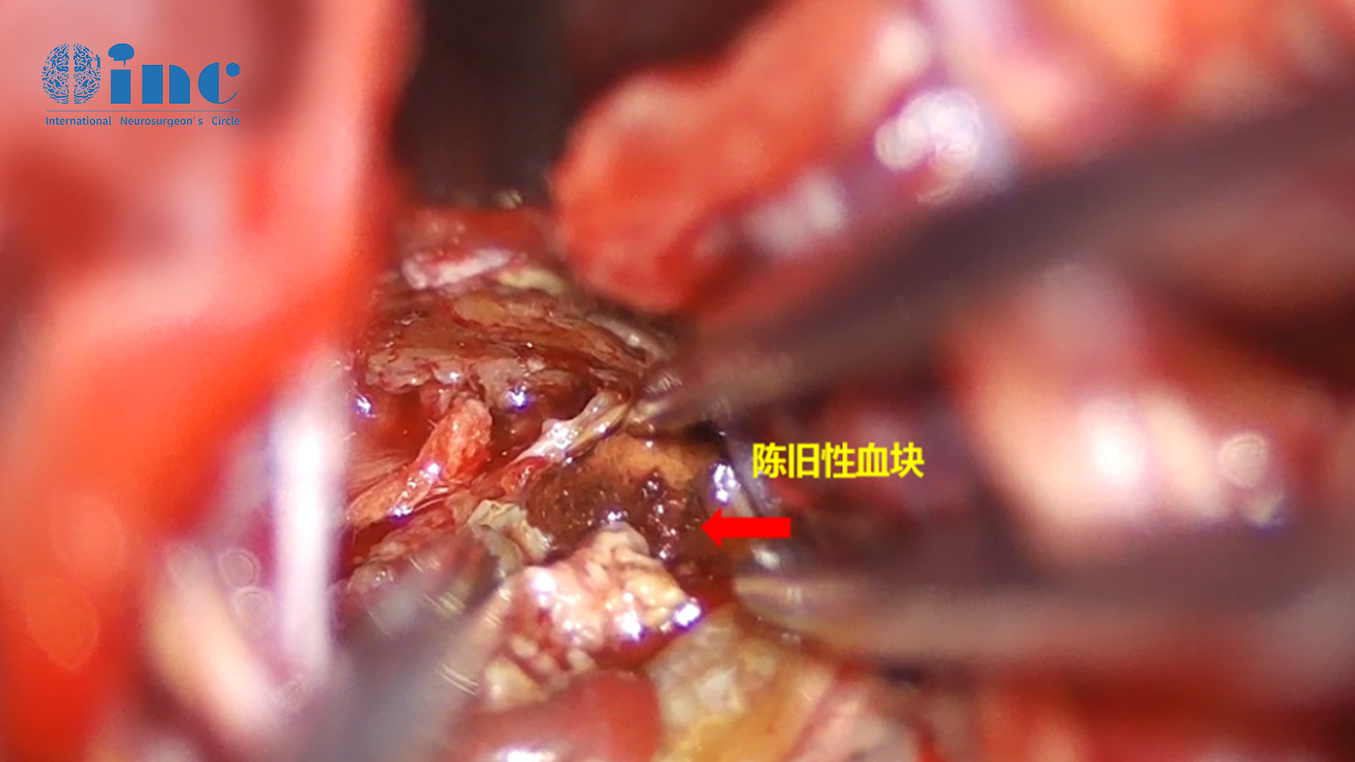 腦干海綿狀血管瘤手術(shù)