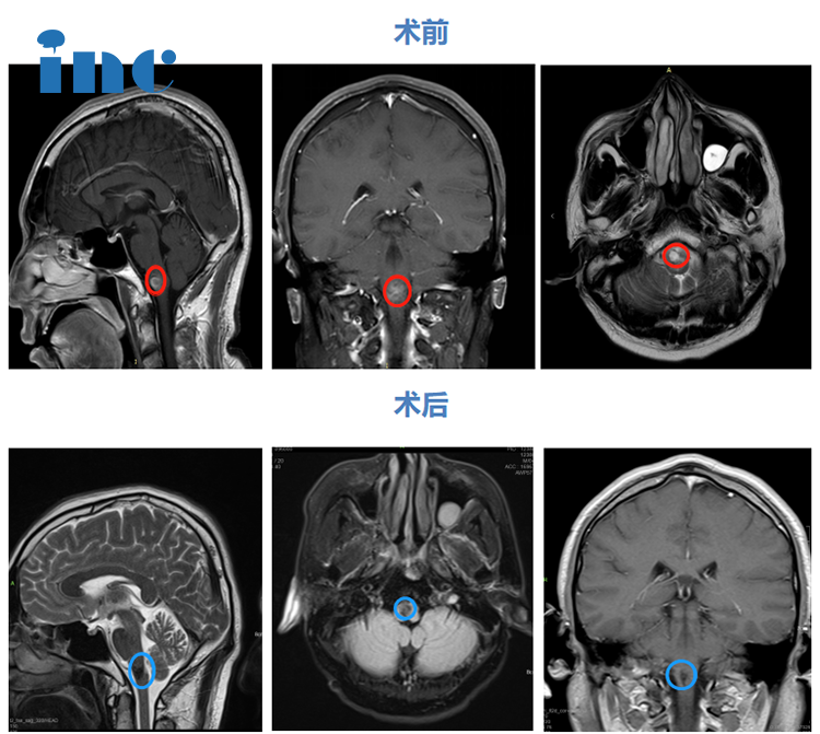 腦干延髓海綿狀血管瘤