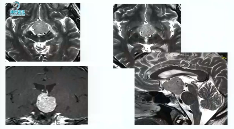 術前MRI