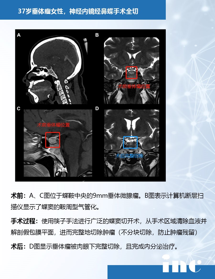 垂體瘤案例