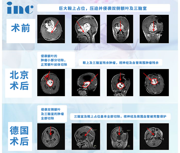 視神經(jīng)膠質(zhì)瘤案例
