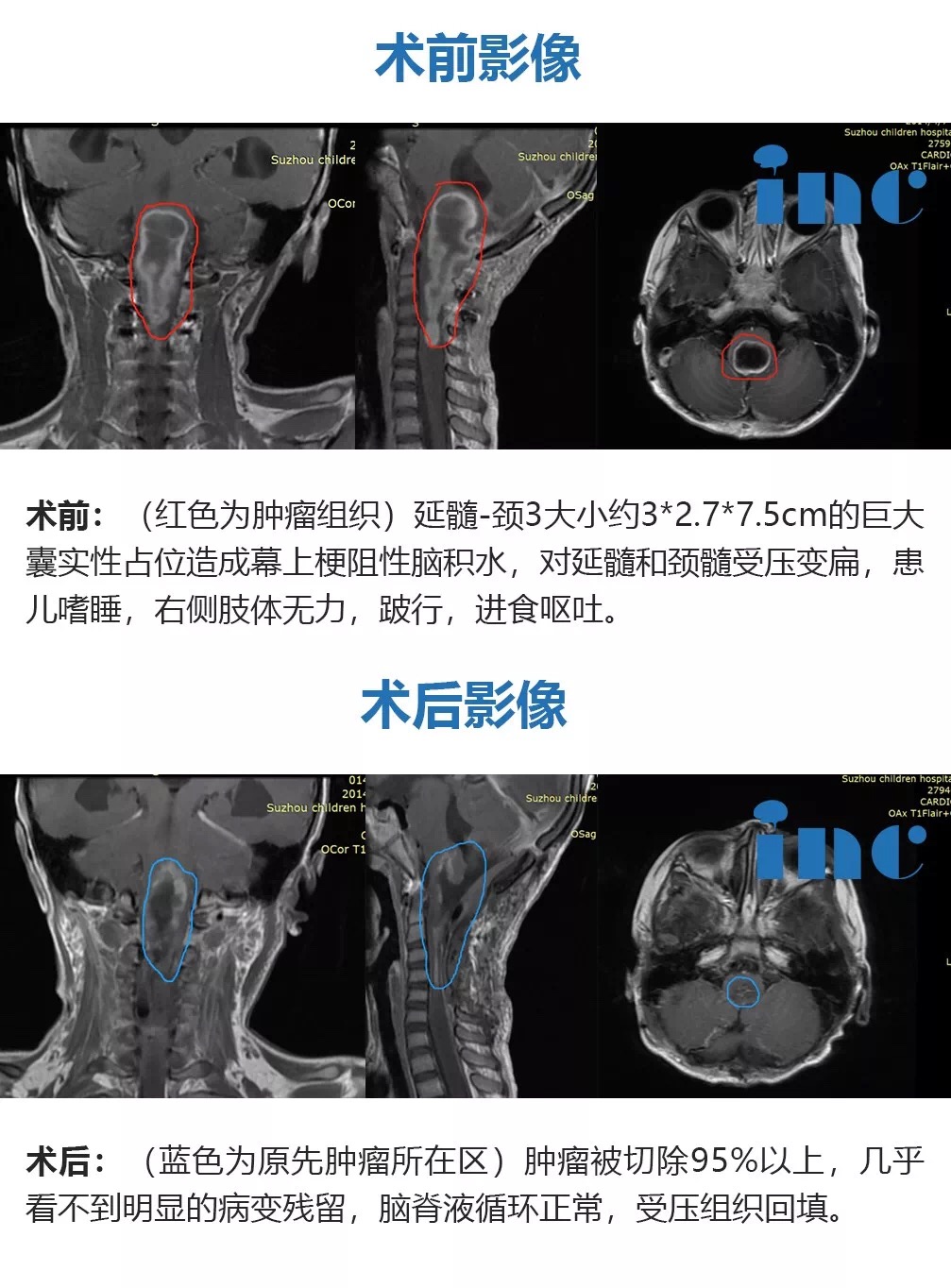 腦干延髓較大腫瘤