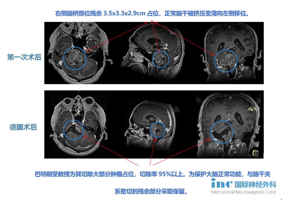 腦干膠質(zhì)瘤案例