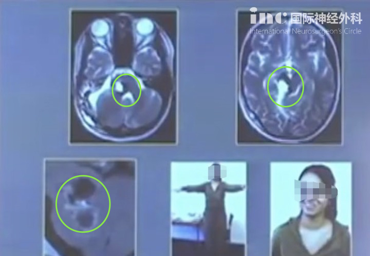 腦干海綿狀血管瘤案例