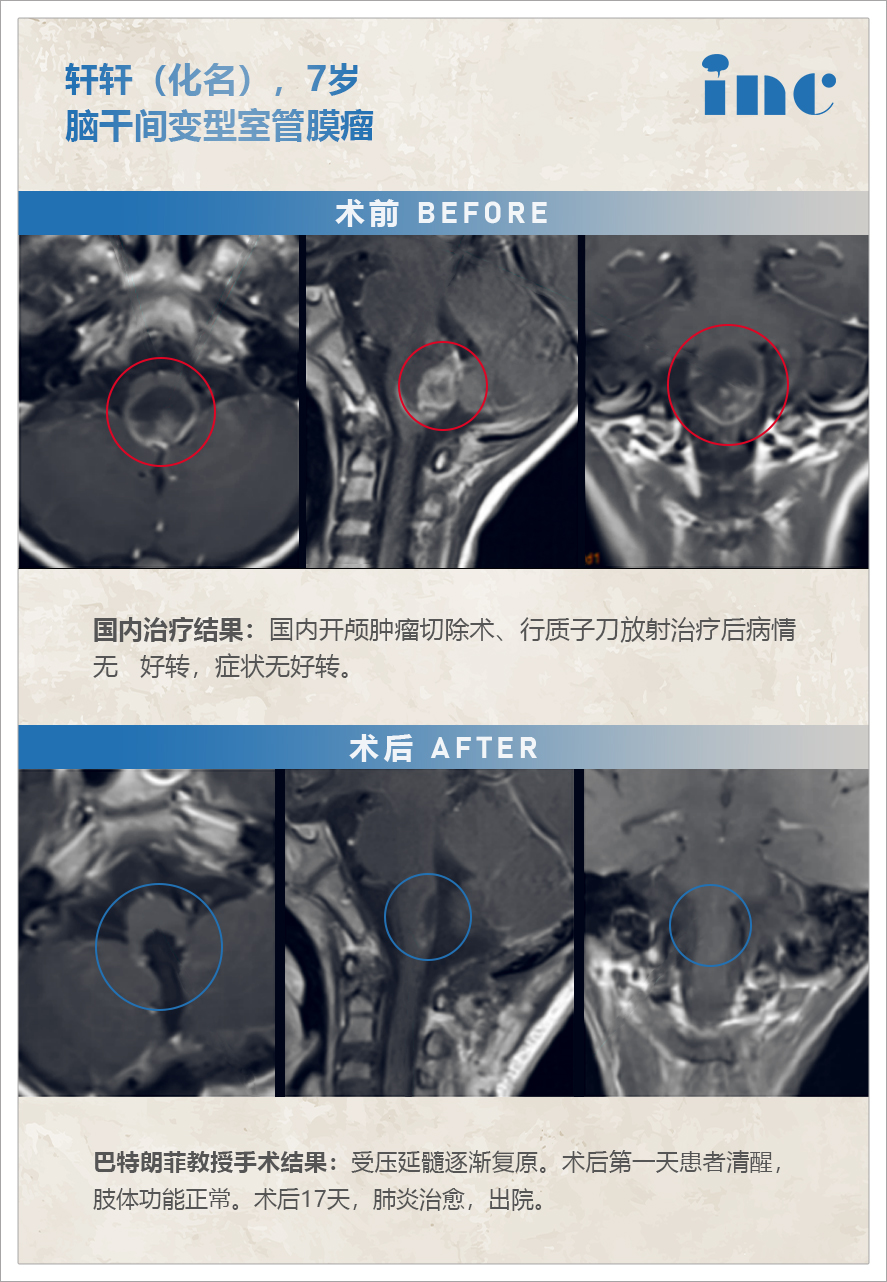 腦干腫瘤室管膜瘤案例