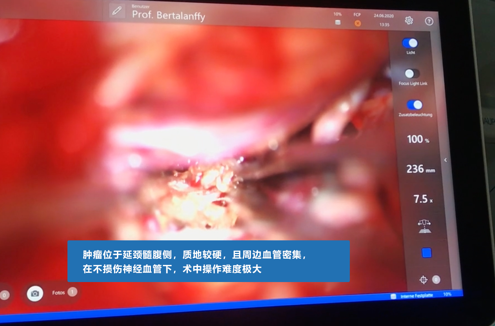 腦血管瘤案例