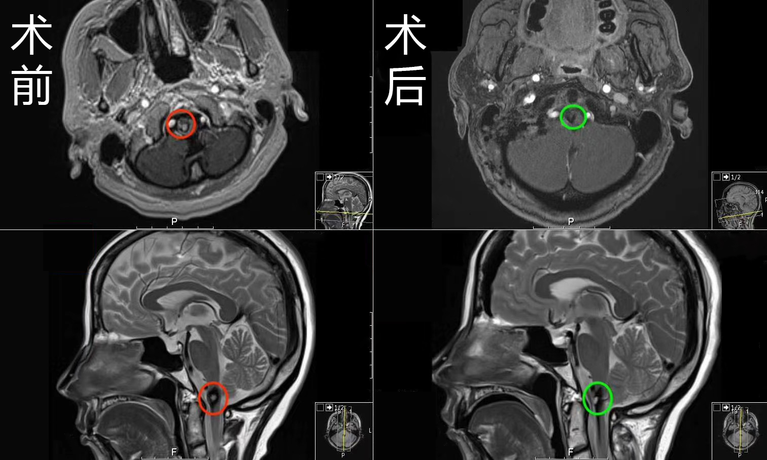 腦干血管病變案例對比