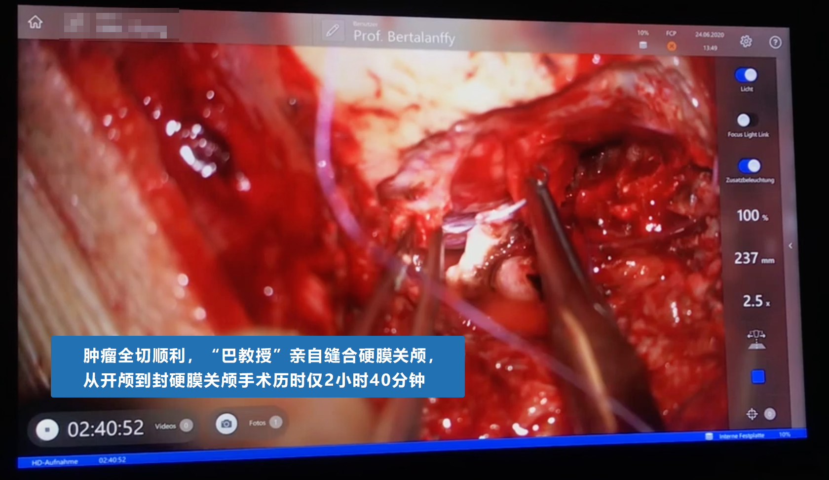 腦干血管病變案例