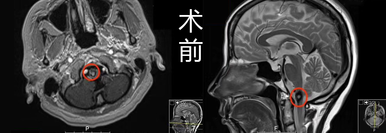 <a href='/naoxueguanliu/' target='_blank'><u>腦海綿狀血管瘤</u></a>