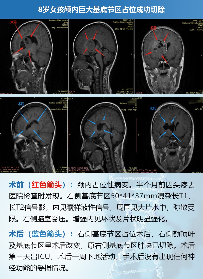 <a href='/naoliu/' target='_blank'><u>腦瘤</u></a>案例