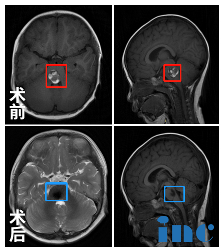 腦干<a href='/jiaozhiliu/' target='_blank'><u>膠質(zhì)瘤</u></a>案例