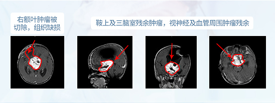 <a href='/jiaozhiliu/' target='_blank'><u>膠質瘤</u></a>手術