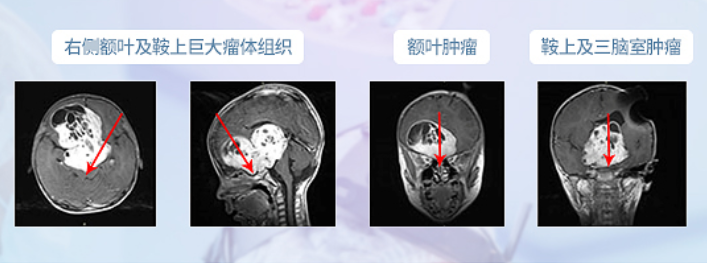 術前MR