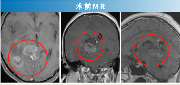 腦膠質(zhì)瘤