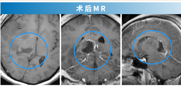 腦膠質(zhì)瘤