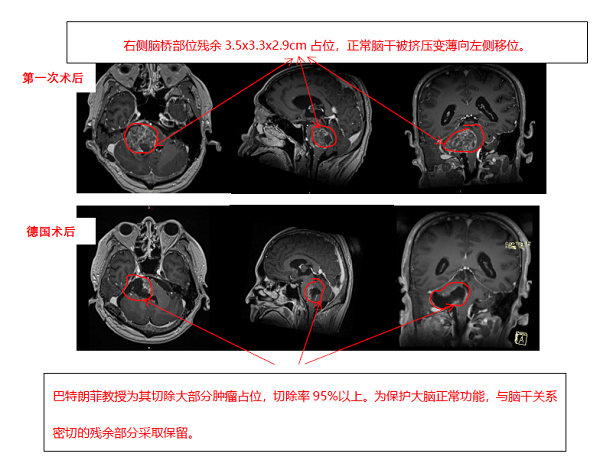 腦干膠質(zhì)瘤案例