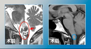 腦海綿狀血管瘤