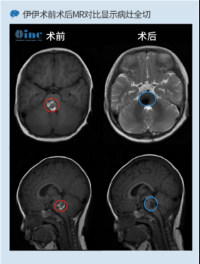 腦干海綿狀血管瘤1