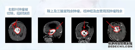 鞍區(qū)腫瘤 案例2