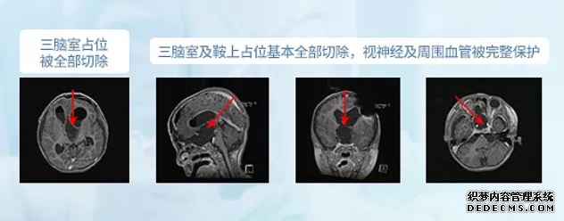 鞍區(qū)腫瘤