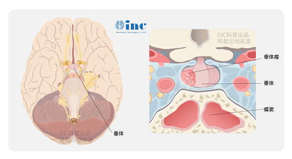 <a href='/naochuitiliu/' target='_blank'><u>垂體瘤</u></a>有哪些癥狀表現(xiàn)