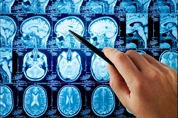 腦海綿狀血管瘤MRI