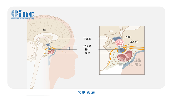 顱咽管瘤術后能活多久