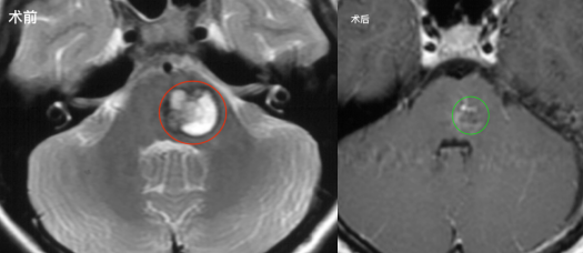 腦干海綿狀血管瘤保守治療