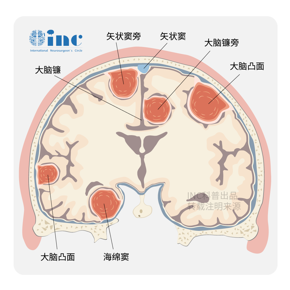 間變性腦膜瘤