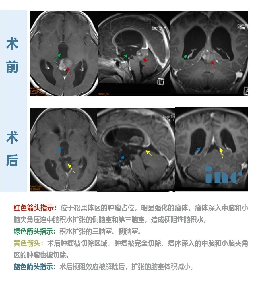 松果體細胞瘤