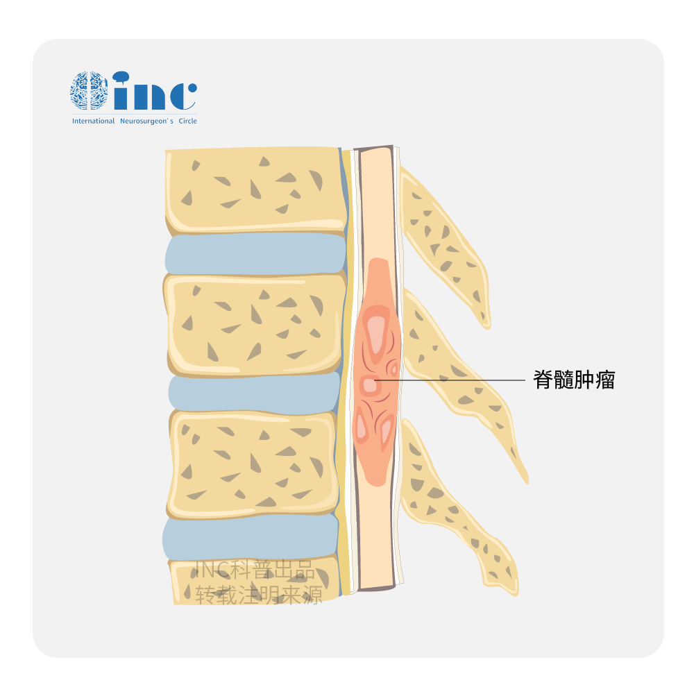 脊髓髓內(nèi)血管母細(xì)胞瘤是什么病嚴(yán)重嗎？