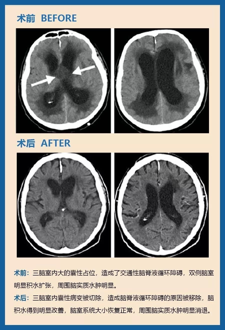 顱咽管瘤有什么危害？