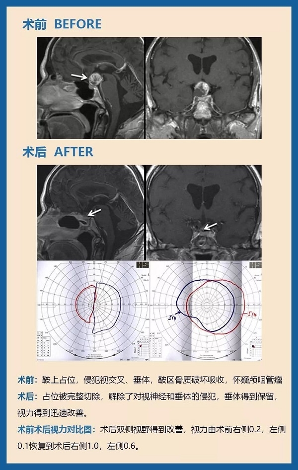 顱咽管瘤有什么危害？案例