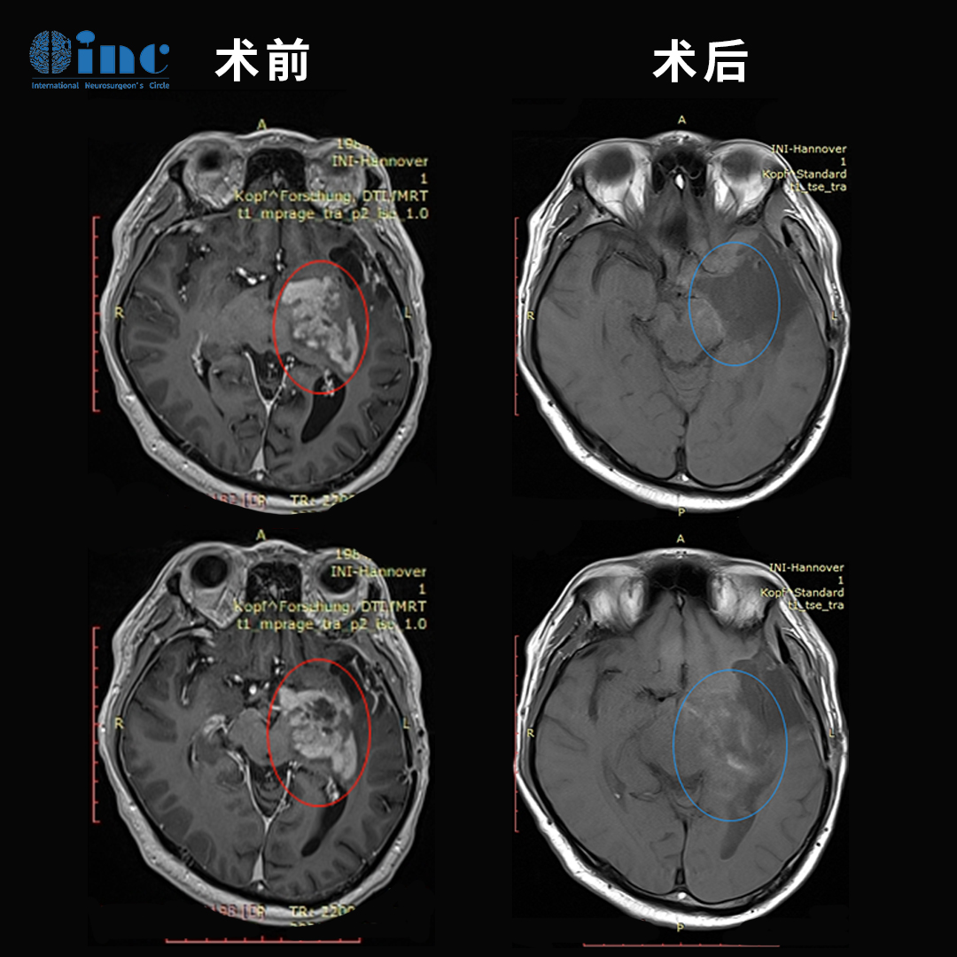 復(fù)發(fā)膠質(zhì)瘤治療方案案例(質(zhì)子治療)