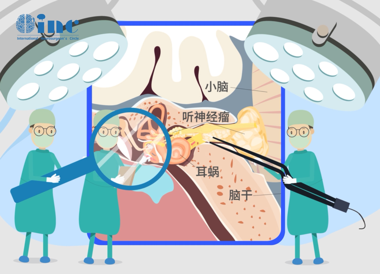 聽神經(jīng)瘤放療怎么樣？