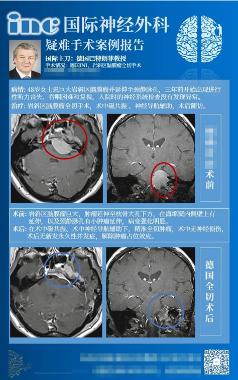 巖斜區(qū)腦膜瘤手術(shù)九死一癱