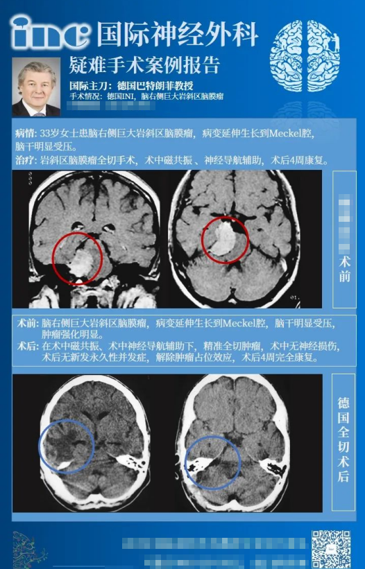巖斜區(qū)腦膜瘤手術(shù)風(fēng)險